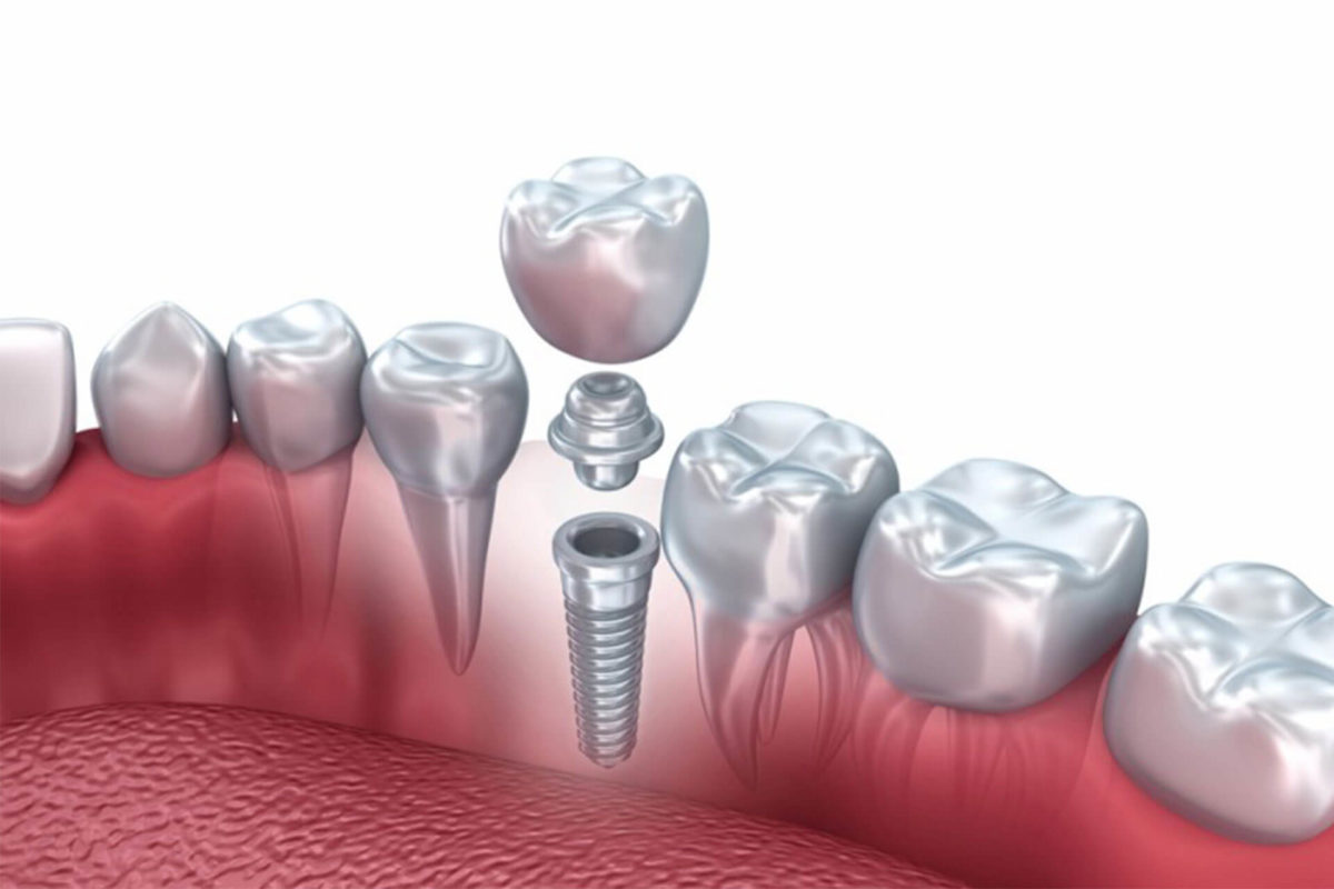 What Makes Dental Implants So Expensive?