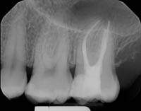 After root canal_img