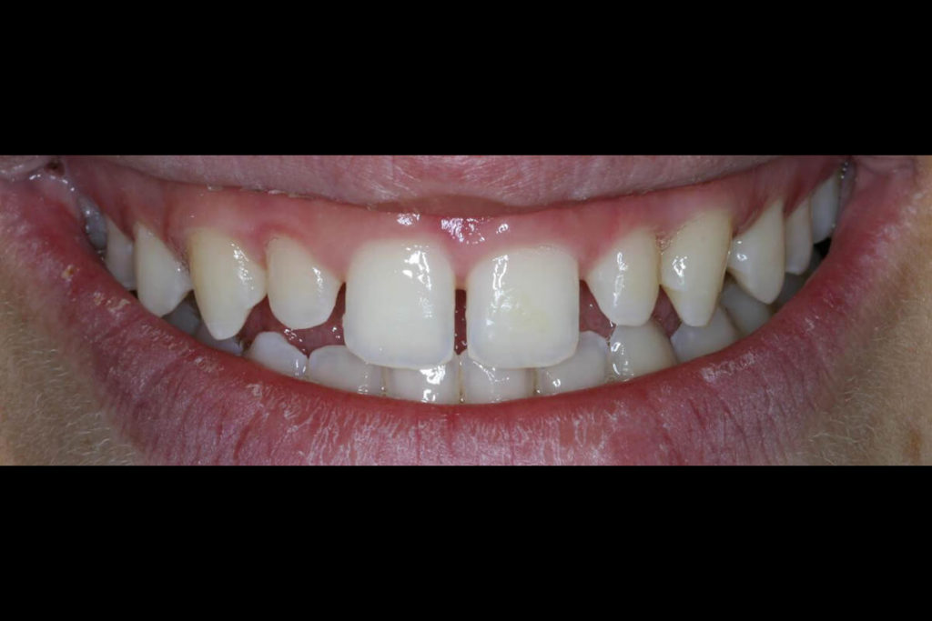 Peg_Laterals1 – Smiles of Virginia Family Dental Center