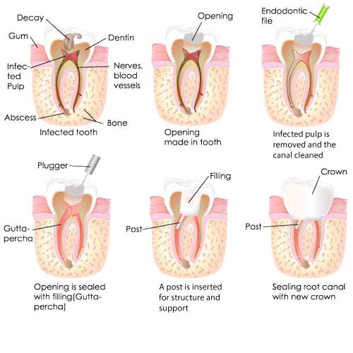 What Is A Root Canal_img