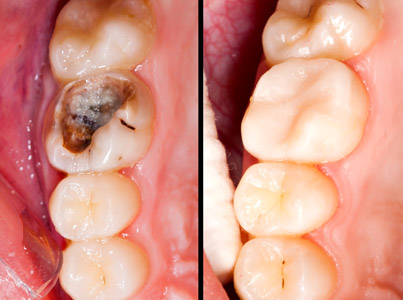 dental-composite-example_img