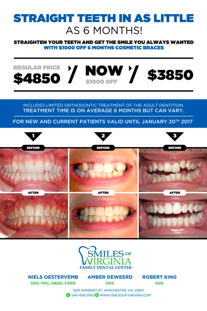 6-Month Cosmetic Braces