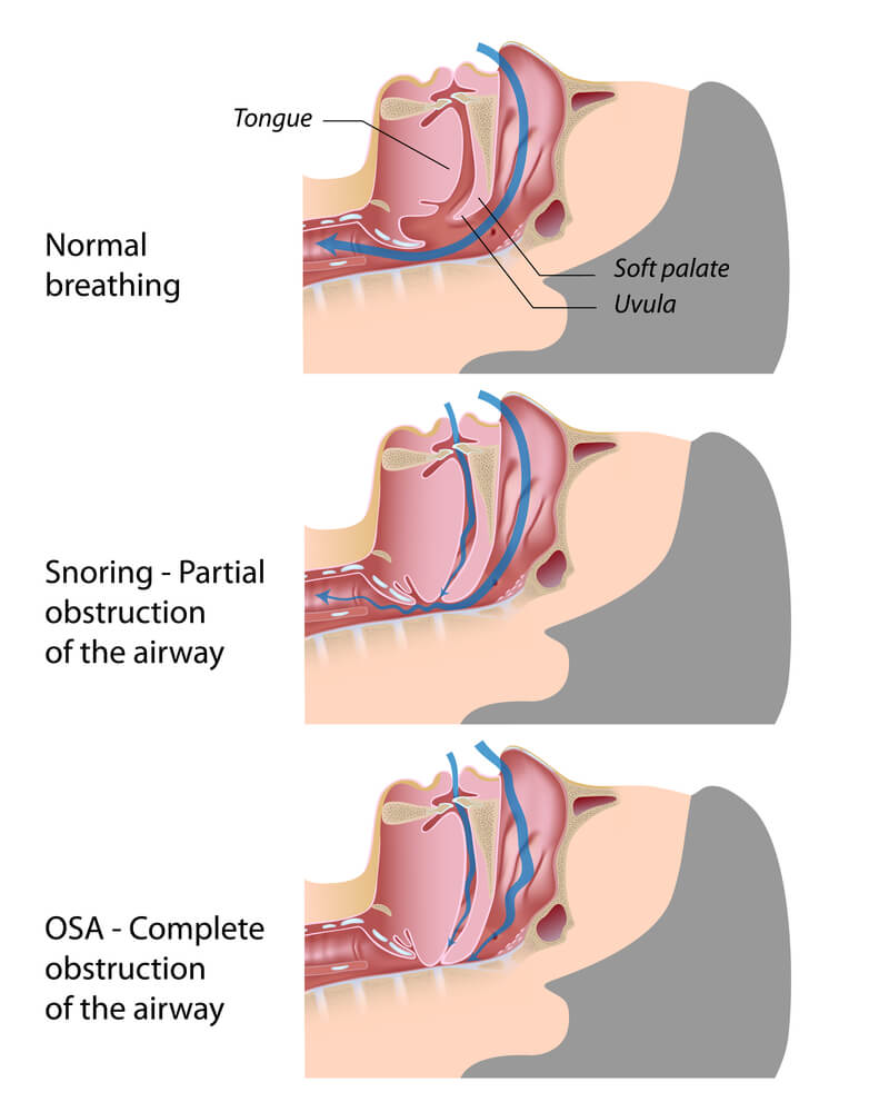 how-snoring-works-while-sleeping_img