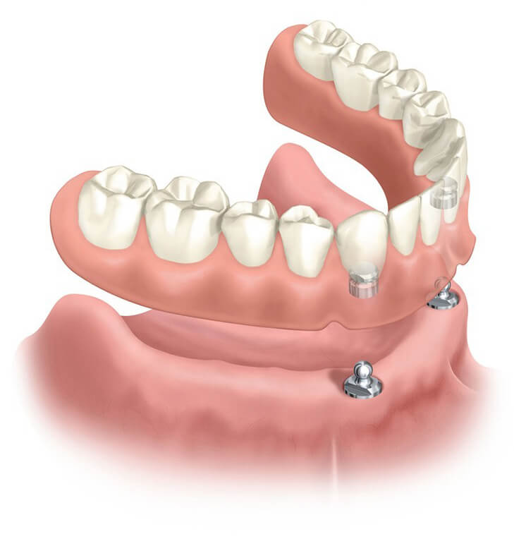 implant-img-dentures