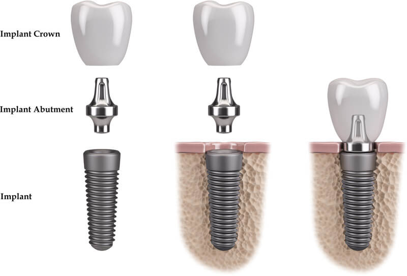 implantparts_images