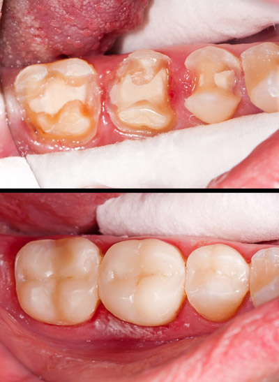 inlays-and-onlays-img