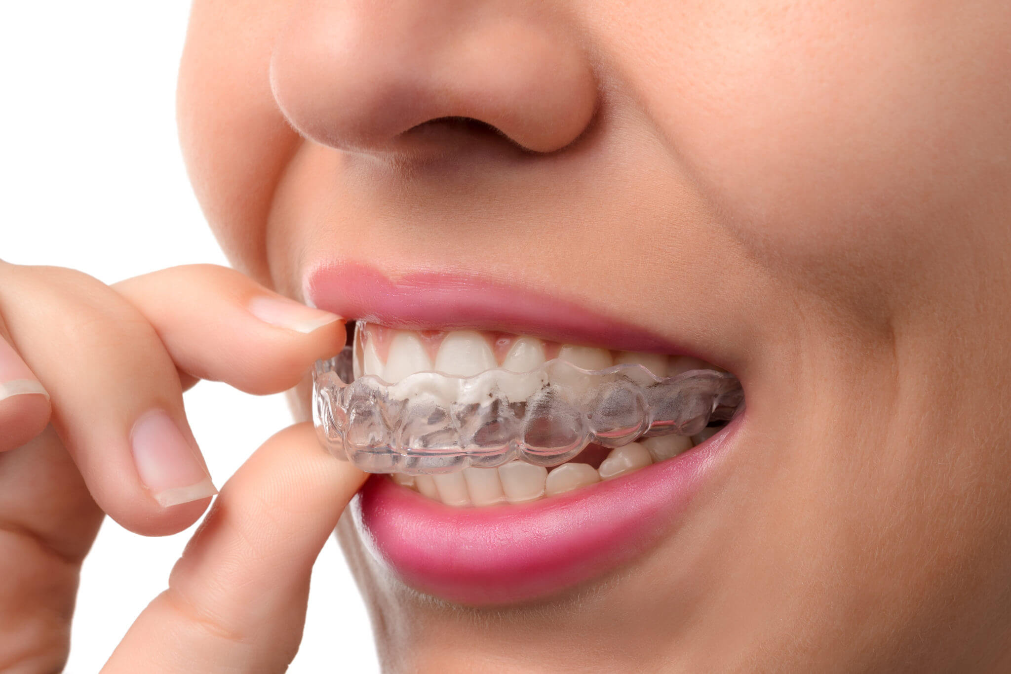 invisalign_img1