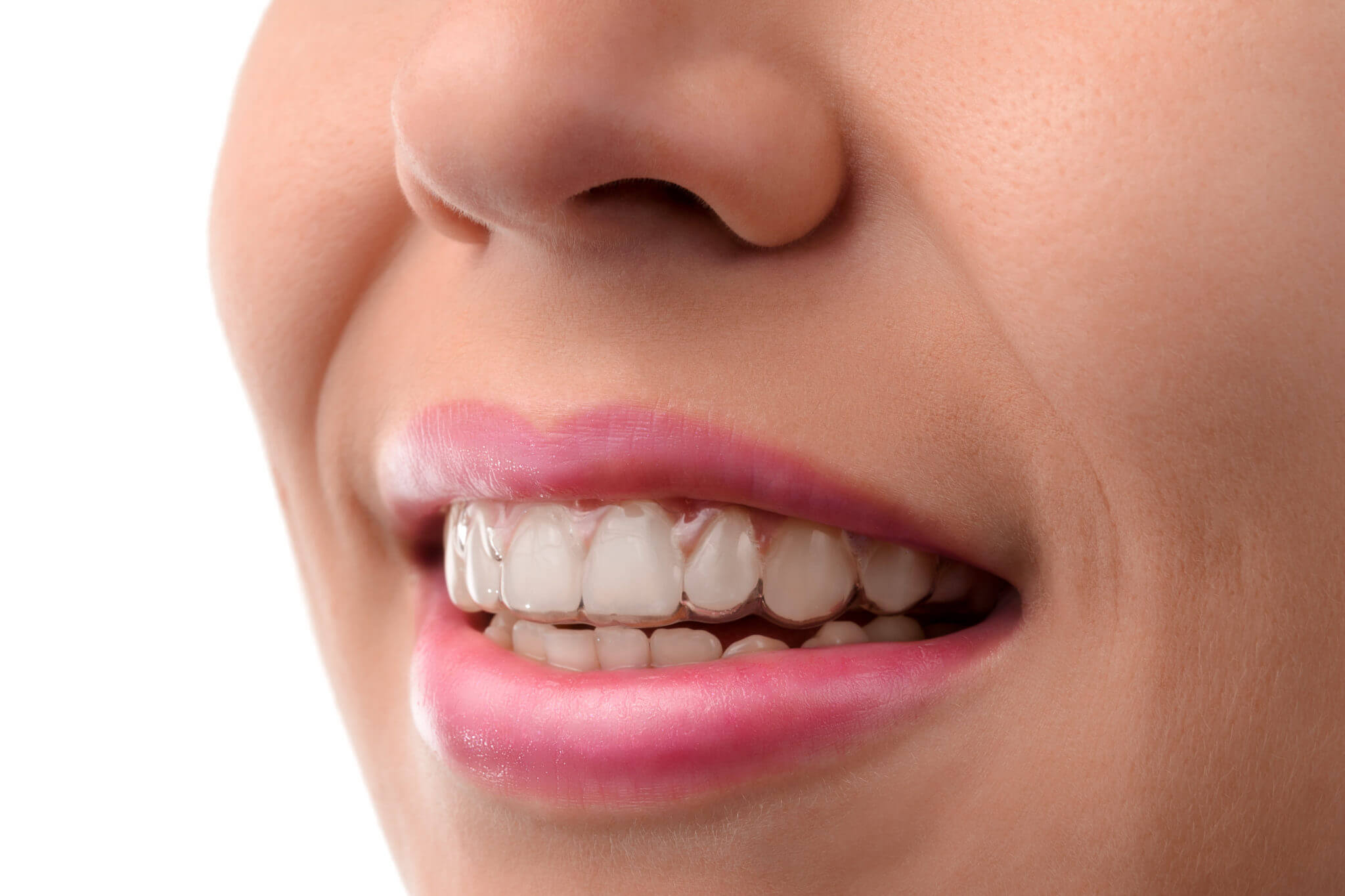 invisalign_img2