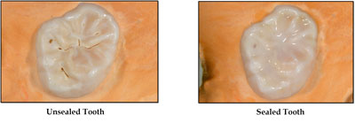 sealed-tooth-sealant