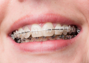 smile-with-brace_images