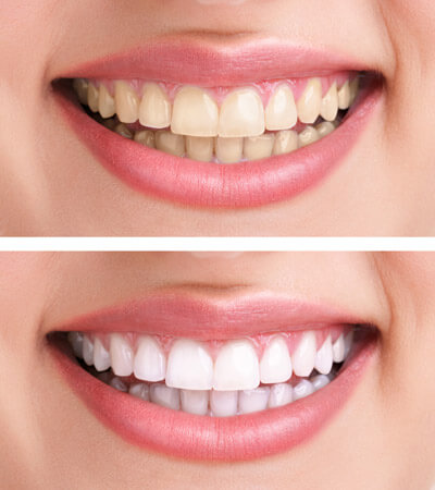 tooth-whitening_images