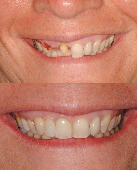 implant before and after