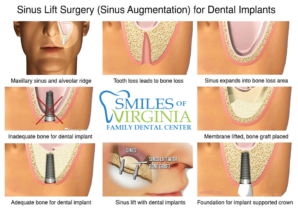 the-process-of-lifting-the-sinus-dental-implant