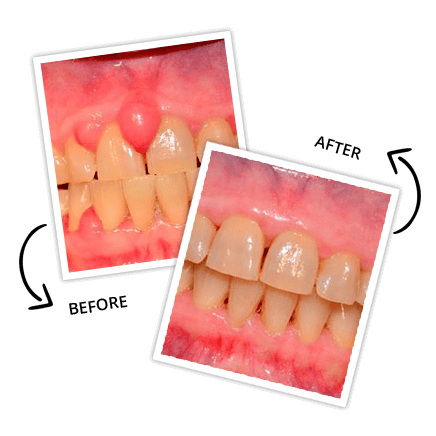 Benefits Of Laser Dentistry (1)