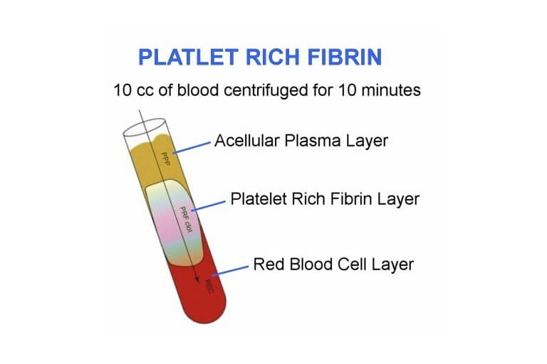 Benefits Of PRP And PRF (1)