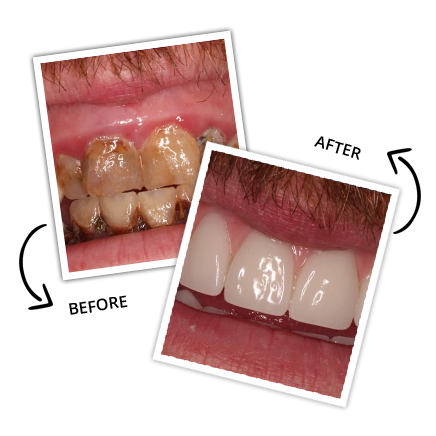 Final Teeth The Same Day