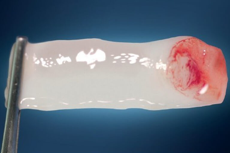 Platelet Rich Fibrin (1)