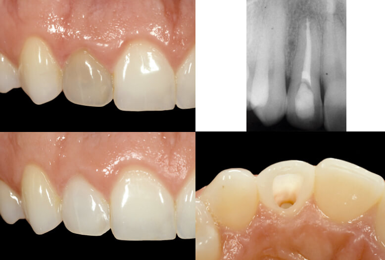 Teeth Whitening and Bleaching Dentist in Winchester Smiles of Virginia