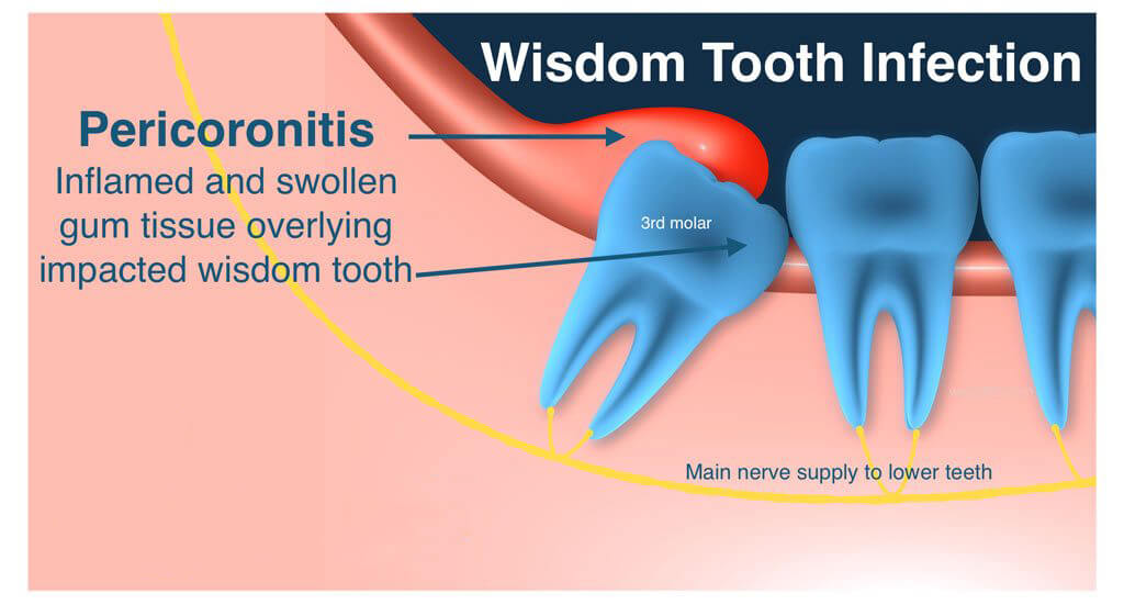 pericoronitis2
