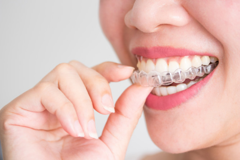 Why You Need Clear Aligner Treatment For Your Teeth Straightening Procedure