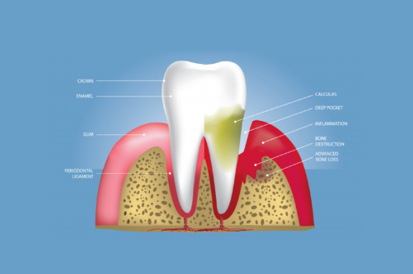 The 3 Stages of Gum Disease