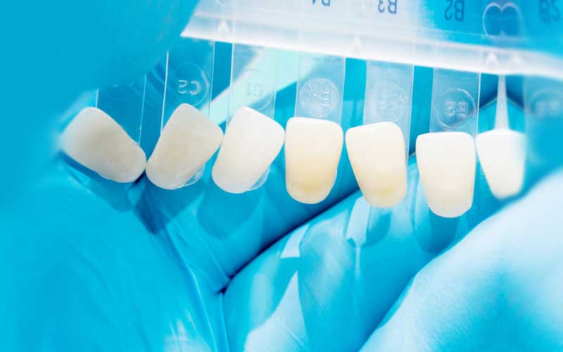 Dental Veneers: What You May Know And May Not Know