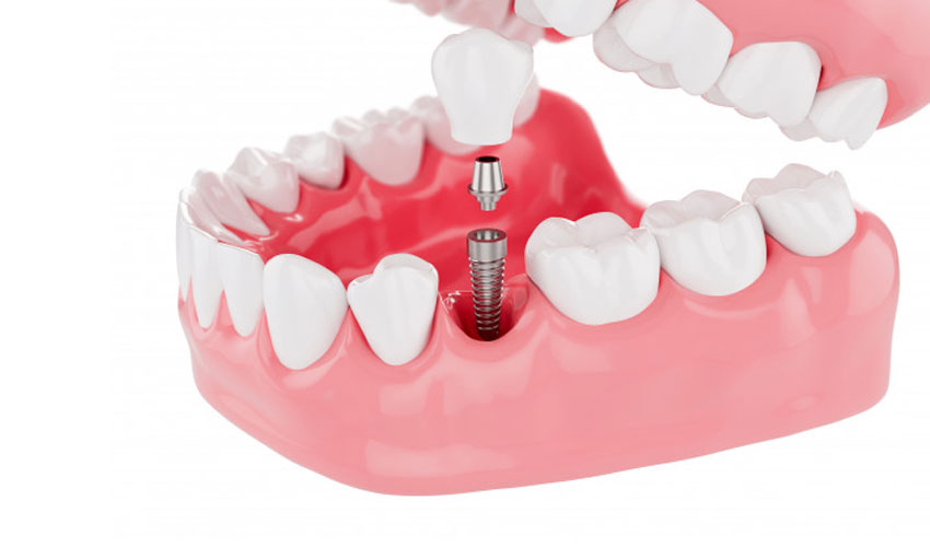 Cost & Benefits of Dental Implants