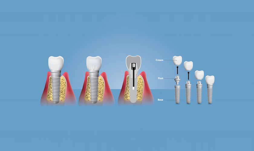 Restore Your Perfect Smile With Dental Implants!