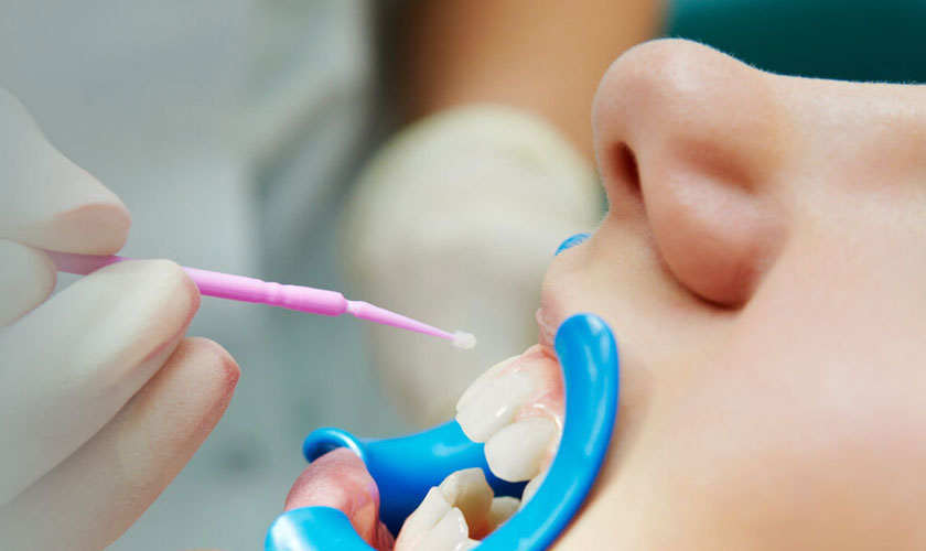 Prevent Your Tooth Decay With Dental Sealants Smiles Of Virginia
