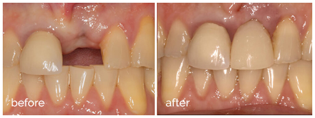Anterior_Implant_1_before_after