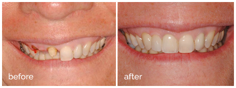 Anterior_Implant_before_after
