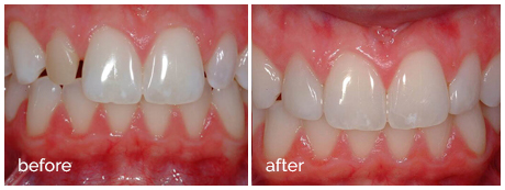 Veneers__1_before_after