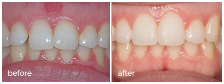 ortho_before_after