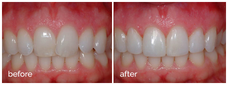 veneers_before_after