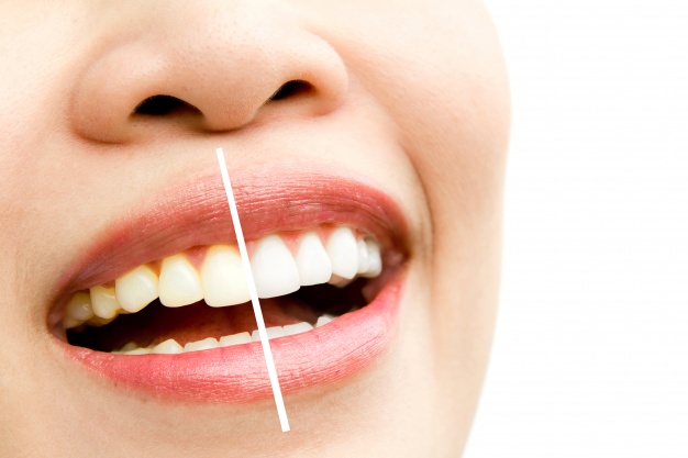 What Is The Cost Of Teeth Whitening?