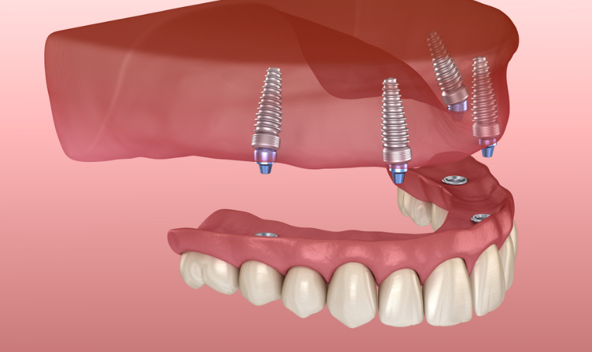 implant supported dentures