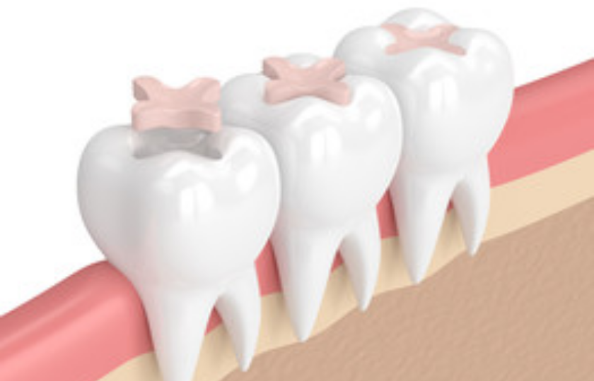 How Are Inlays & Onlays Beneficial For Dental Health?