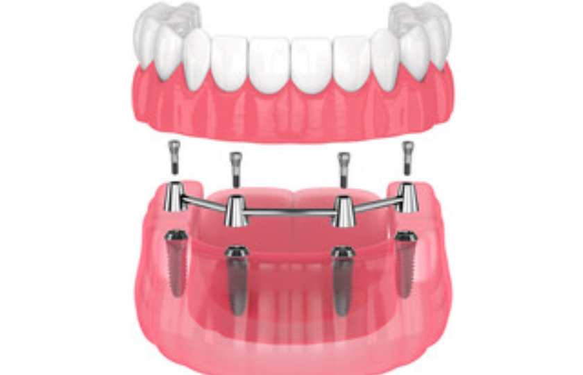 Implant-Supported Dentures: Dentist’s Guide To Maintenance