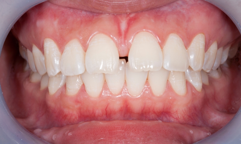 What is Diastema? How Gaps Between Teeth Occur