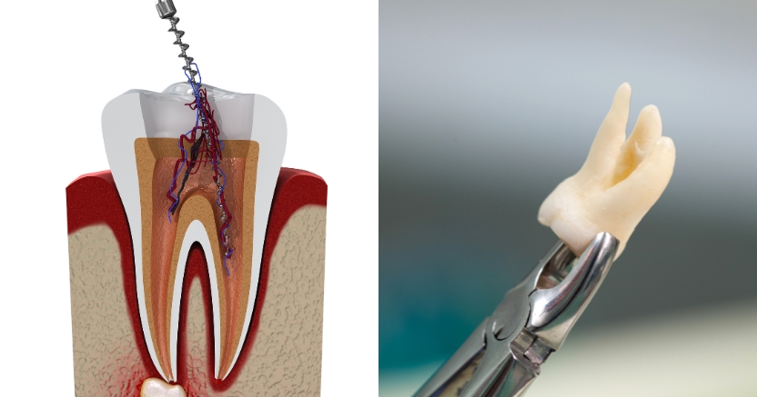 root canal vs extraction