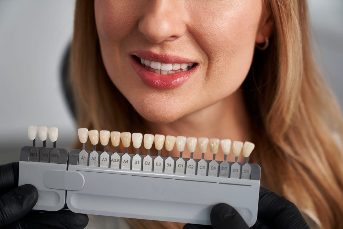 Veneers in Winchester